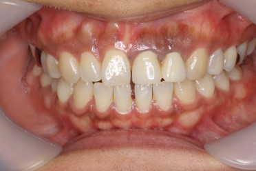 症例１ 歯茎の黒ずみ除去 before