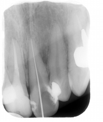 根管治療 治療例1 虫歯で歯の痛みで来院されました。