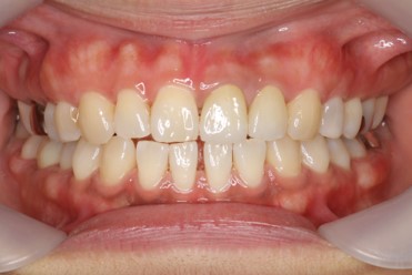 症例１ 歯茎の黒ずみ除去 after