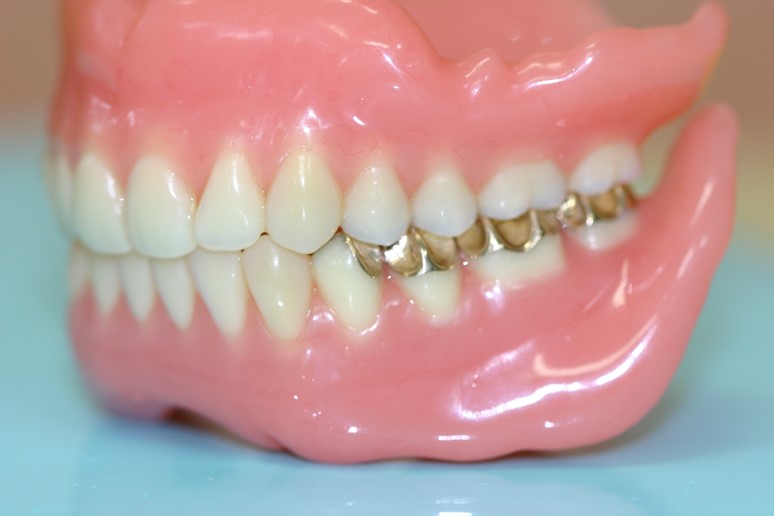 シラシステムによる入れ歯製作①