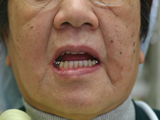 患者様の口腔内に人工歯を配列した義歯を入れてみます。