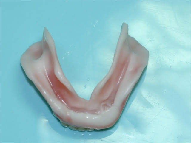 シラシステムの入れ歯の調整 初回 下顎義歯内面