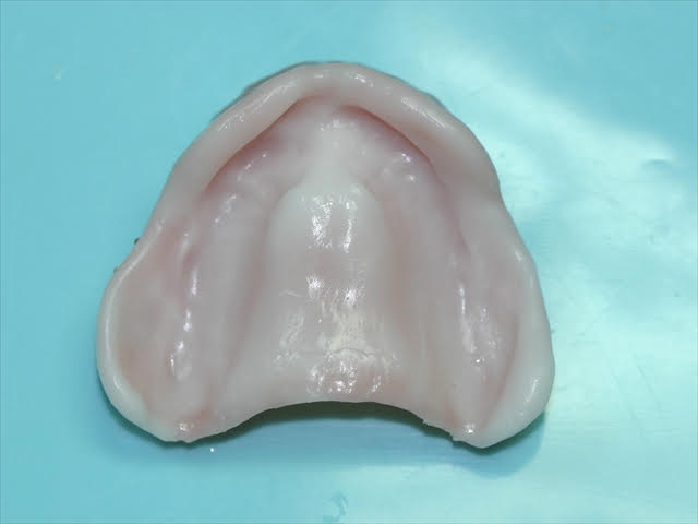 シラシステムの入れ歯の調整 初回 上顎義歯内面