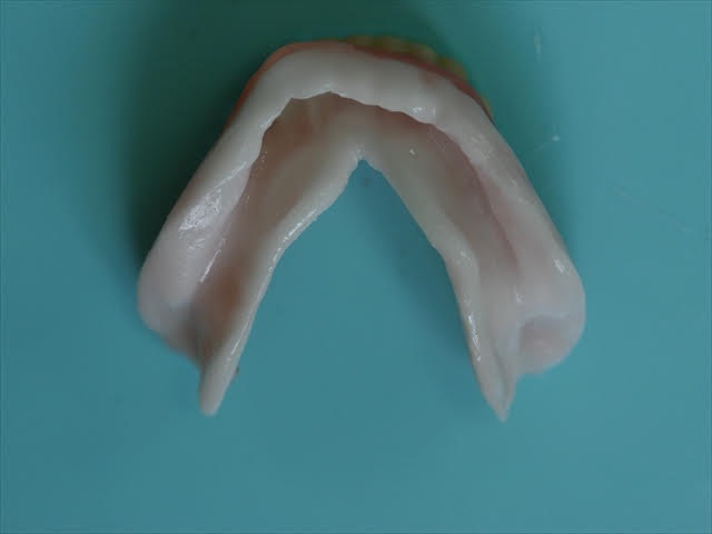 シラシステムの入れ歯の調整 10週間後①