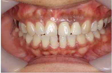 レーザー治療　症例１ 歯茎の黒ずみ除去 before