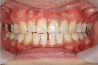 レーザー治療　症例１ 歯茎の黒ずみ除去 after