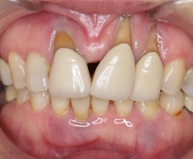 歯茎の回復症例１ before