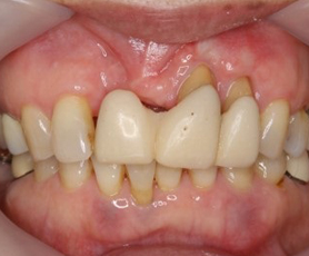 歯茎の回復症例１ 装着時