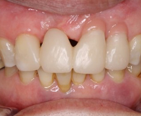 歯茎の回復症例１ after