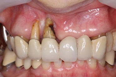 歯茎の回復症例2 before