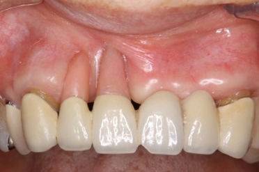 歯茎の回復症例2 after