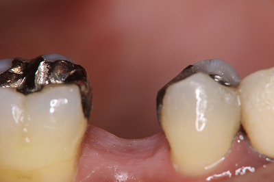 歯冠破折 ①歯の欠損があります。
