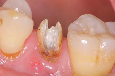 歯冠破折 ②金属冠を除去すると、破折線が見えます。
