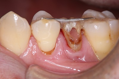 歯冠破折 ⑤抜歯した歯を接着して元の位置に再植して2か月間固定します。