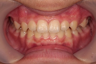 舌側弧線装置　矯正症例 after