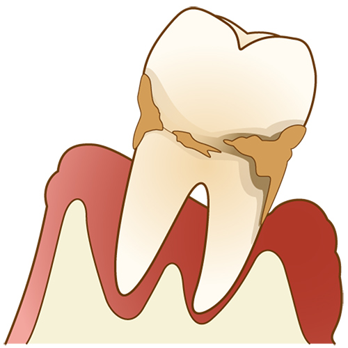重度の歯周病に対応するフラップ手術