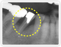 点線部 右顎拡大図 骨の後退により、歯の両隣りに黒い影があります。