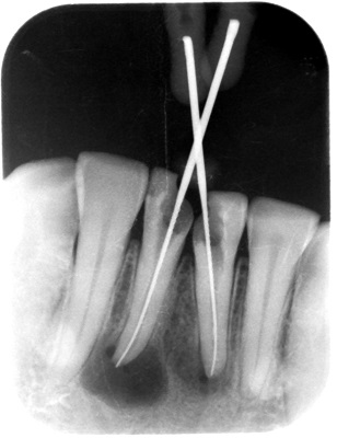 根管治療 治療例3 歯根の先に大きな病巣があります。